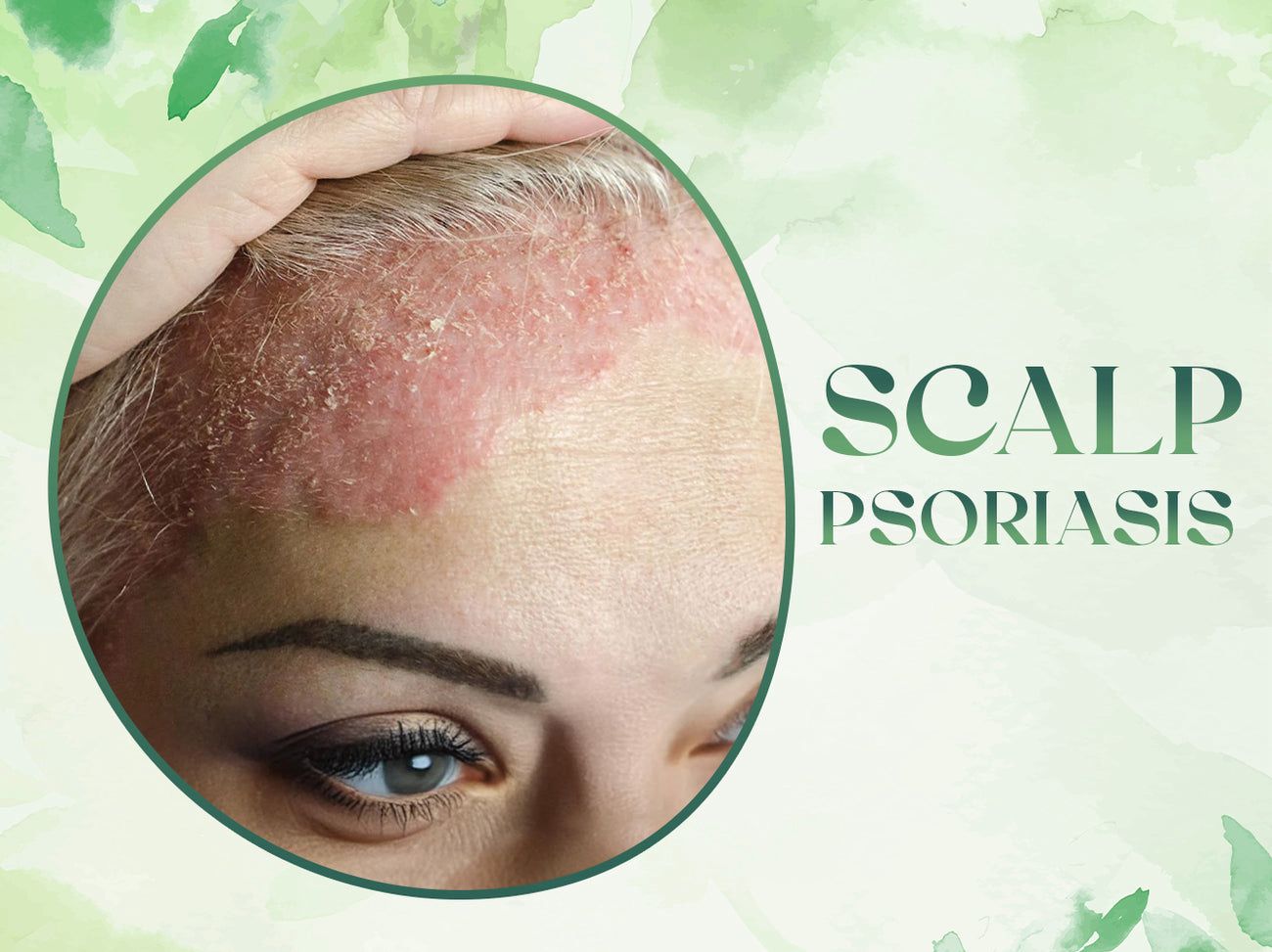 ANCIENT HERB OF INDIA PSORIA OIL ADVANCED AYURVEDIC RELIEF FOR SCALP & SKIN